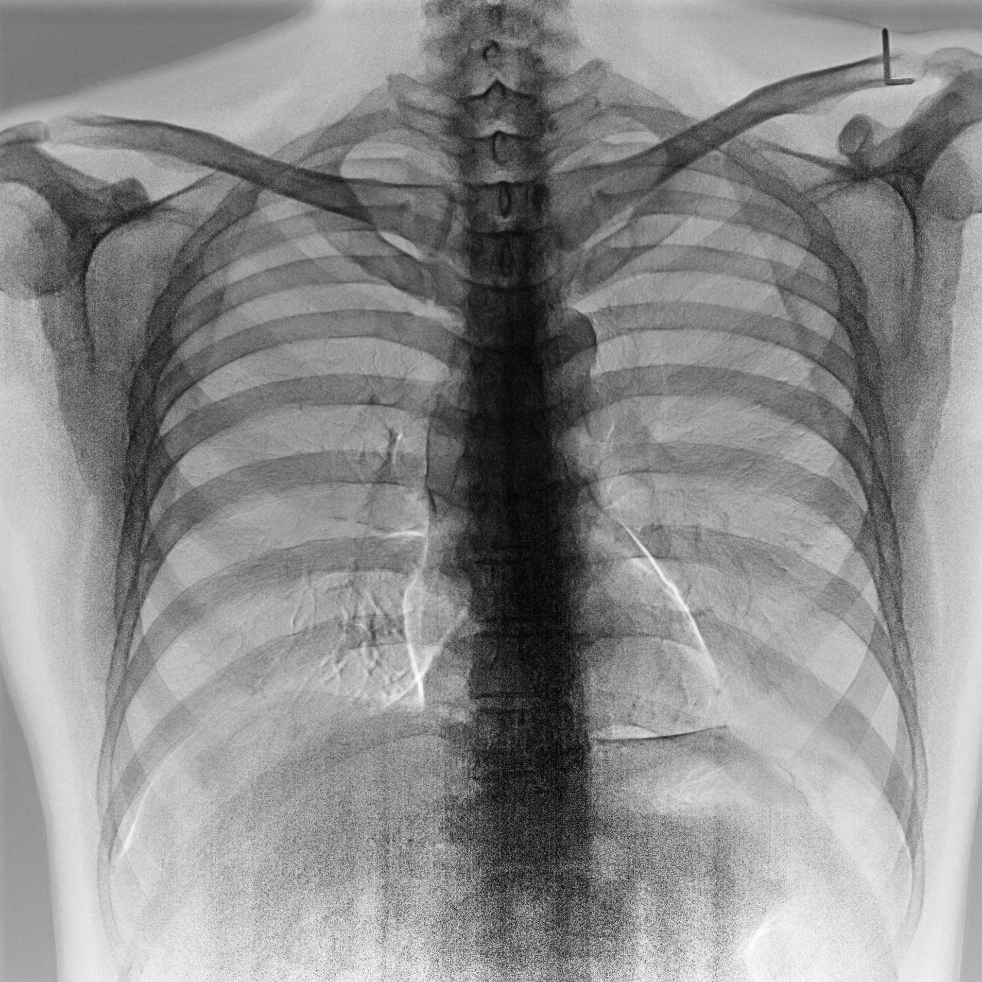 デュアルエナジーサブトラクション撮影による骨のない胸部X線写真